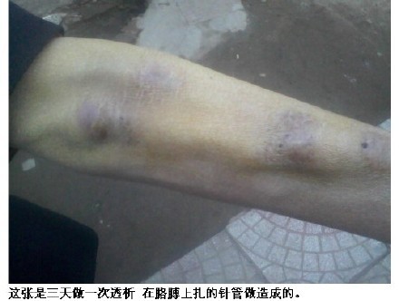 善心莲心 <wbr> <wbr>助医肾衰竭患者