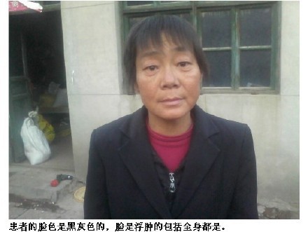 善心莲心 <wbr> <wbr>助医肾衰竭患者