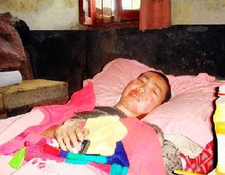善心莲心 <wbr>捐助强直性脊柱炎重症患者刘发飞