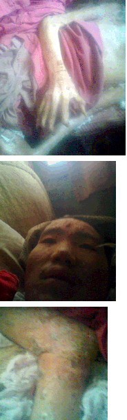 善心莲心 <wbr>捐助强直性脊柱炎重症患者刘发飞