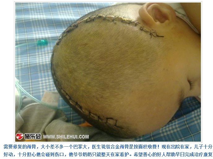 善心莲心&nbsp;<wbr>助医陈东升颅骨修复手术费用