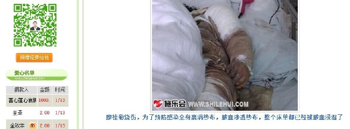 善心莲心&nbsp;<wbr>助医严重烧伤患者廖桂菊