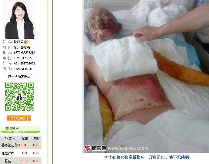 善心莲心&nbsp;<wbr>助医烧伤患者章楠