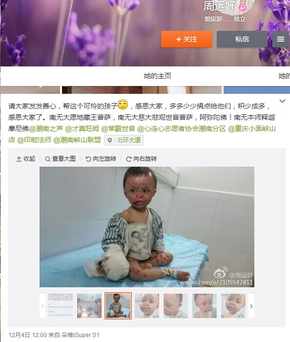 善心莲心&nbsp;<wbr>捐助烧伤患儿卢坤鑫疗费